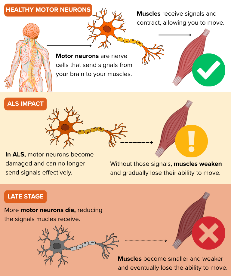 Healthy motor neurons send signals to muscles. ALS damages motor neurons, weakening those signals and the muscles.